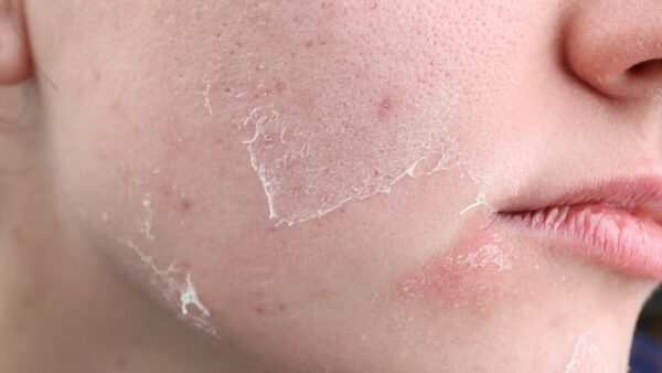 ¿Piel seca por el frío La solución no es otra crema